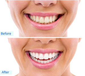 Beautiful Smile® Zahnaufhellungsset mit Smartphone-Anschluss (iPhone, Android, USB)